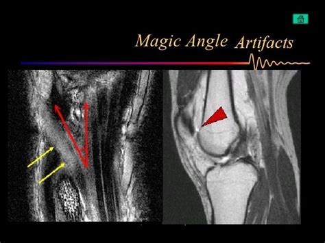 Optimizing MRI Protocols to Minimize the Magic Angle Artefact